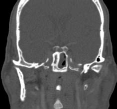 Rhinoscleroma | Image | Radiopaedia.org