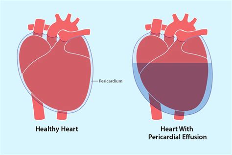 Pericardial Effusion: Causes, Symptoms, Diagnosis & Treatment