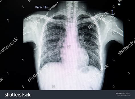 Chest Xray Film Patient Interstitial Pneumonia Stock Photo 1455136874 ...