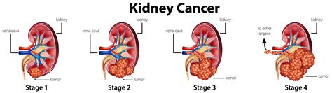 Diagram showing different stages of kidney cancer 292272 Vector Art at Vecteezy