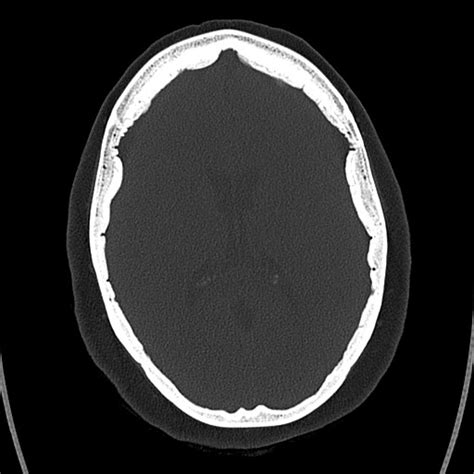 Hyperostosis frontalis interna | Image | Radiopaedia.org