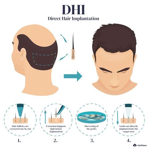 Top 128 + Dhi hair transplant in usa - polarrunningexpeditions