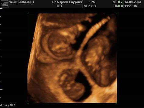 3D Ultrasound Scan photos of Multiple Pregnancy twins triplets ...