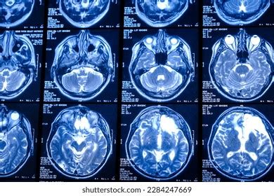 Mri Scan Brain Diagnosis Medical Examination Stock Photo 2284247669 ...