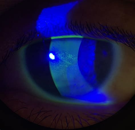 Whorl-like keratitis on keratoconic eye : r/optometry