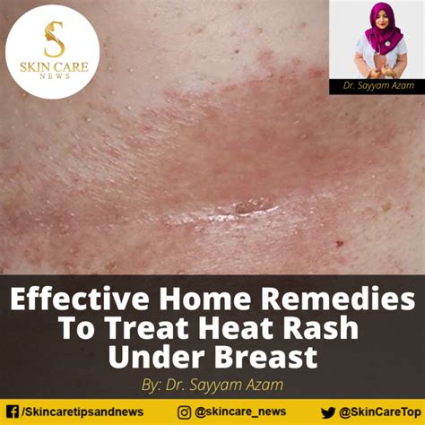 Effective Home Remedies To Treat Heat Rash Under Breast