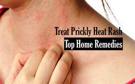 Causes, Symptoms, and Treatments for Heat Rash You Can Do At Home