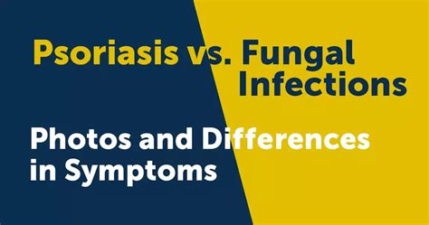 Psoriasis vs. Fungal Infections: Photos and Differences in Symptoms | MyPsoriasisTeam
