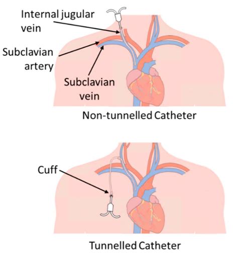 Dialysis Catheters 101 - Renal Fellow Network