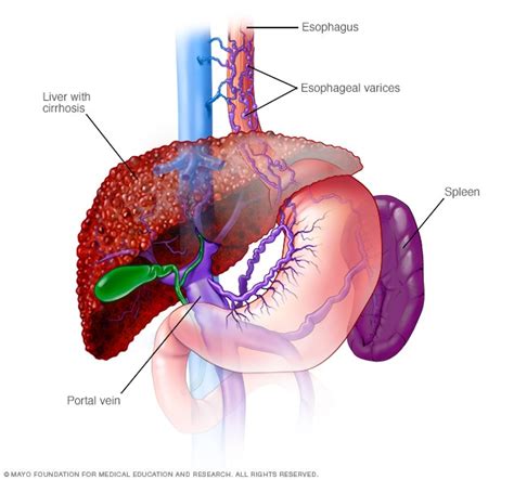 Nonalcoholic fatty liver disease - Symptoms and causes - Mayo Clinic