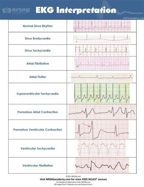 EKG strip interpretation | Nursing school, Ekg interpretation, Nurse