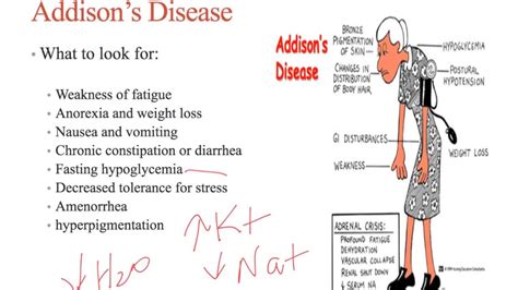 Module 5 Fall 2016 Adrenal Gland Disorders - YouTube