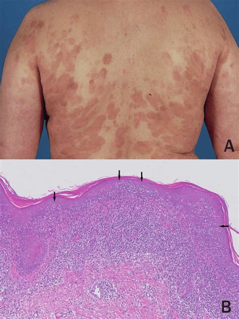 Mycosis Fungoides Symptoms