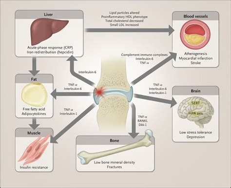 extra articular involvement rheumatoid arthritis - Google Search | Immunology, Rheumatoid ...