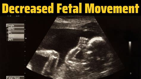 Reasons For Decreased Fetal Movement | Baby Movements During Pregnancy | Fetal Movement Counting ...