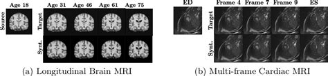 SADM: Sequence-Aware Diffusion Model for Longitudinal Medical Image Generation: Paper and Code ...