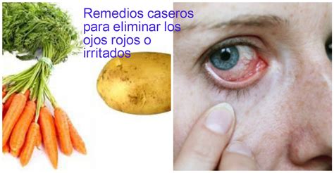 4 Remedios caseros eficaces para quitar los ojos rojos o irritados ~ Belleza y Peinados