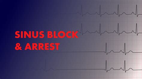 Cardiac Arrest Ekg - img-lollygag