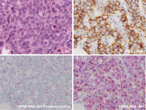 Pathological images of a HER2-positive breast cancer with HER2... | Download Scientific Diagram