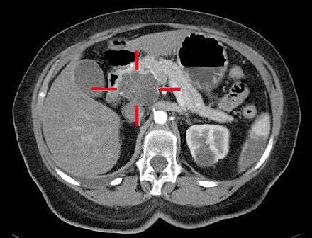Tumore del pancreas - Wikipedia