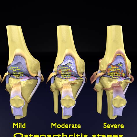 Osteoarthritis stages 3D - TurboSquid 1663612