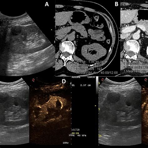 Patients with initial Bosniak 2F lesions, which progressed during ...