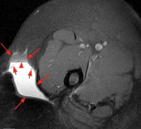 A Comprehensive Guide to Morel Lavallee Lesion