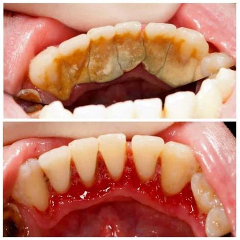 Teeth Cleaning Before and After - Teeth FAQ Blog