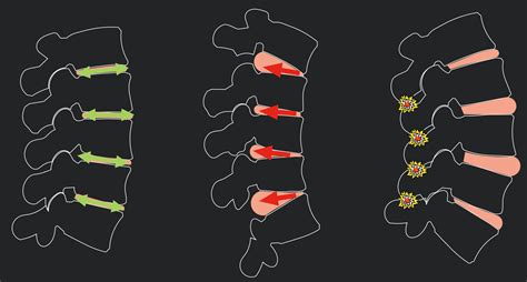 Biomechanics of the spine - posture, forces and structures | Core Advantage