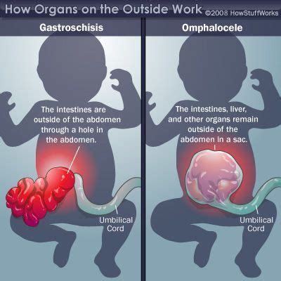 Gastroschisis / Omphalocele | NCLEX Prep and Study Resource | Pinterest ...