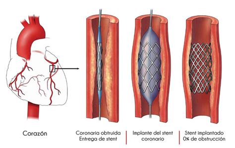 Cateterismo cardíaco | Red. Estudios Cardiovasculares