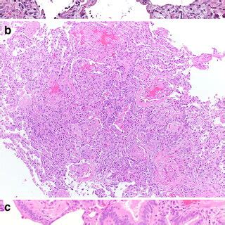 a–c The major pathologic acute lung injury patterns seen in the setting... | Download Scientific ...