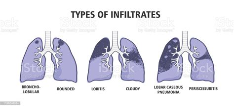 Types Of Infiltrates Pulmonary Tuberculosis Human Lungs Stock Illustration - Download Image Now ...