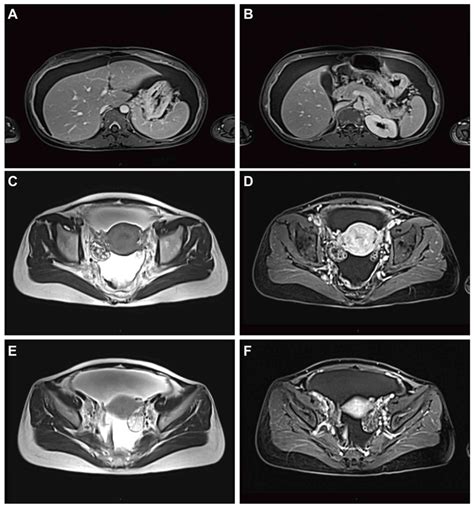 Measurable Krukenberg tumor is preferably characterized as a non-target ...