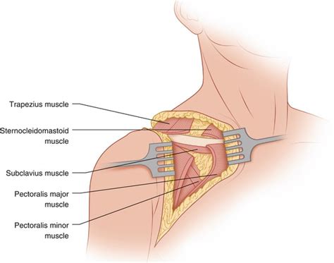 Forequarter Amputation | Oncohema Key