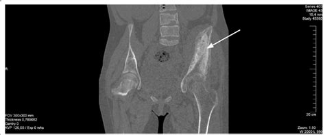 Whole-body CT (pelvis region) showing destruction and sclerosis of the ...