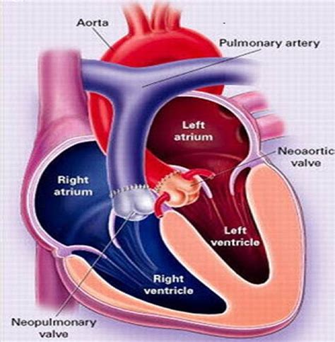 Transposition of the great vessels corrective surgery - wikidoc