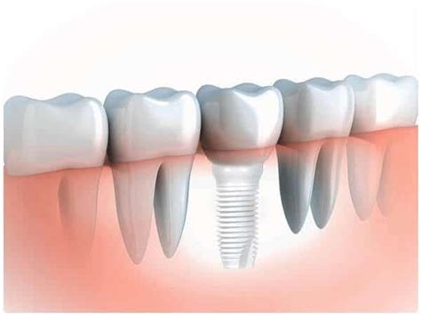 Root Canal Alternatives | Holistic Dental Treatment | Pure Holistic Dental