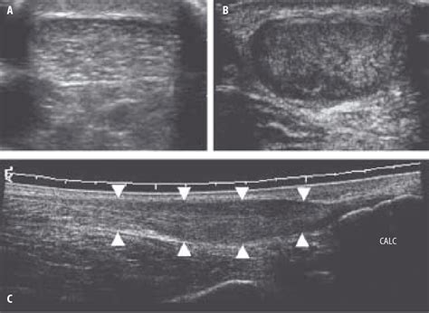 Figure 4.10 from Imaging of the Achilles tendon. - Semantic Scholar