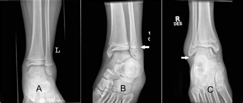 Choosing Wisely: Low Risk Pediatric Ankle Fractures - CanadiEM