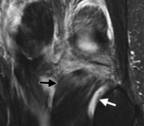 Popliteus muscle strain. Coronal STIR image shows strain of the... | Download Scientific Diagram