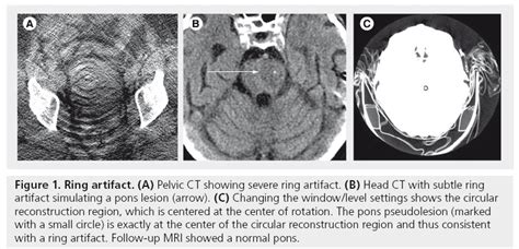 CT artifacts: causes and reduction techniques