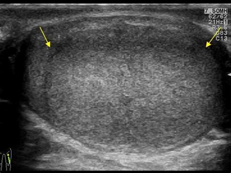 Urinary Tract and male reproductive system | 2.3 Scrotum : Case 2.3.8 ...