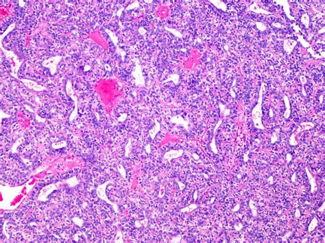 Pathology Outlines - Eccrine spiradenoma