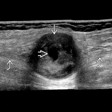 Nerve Sheath Tumors | Radiology Key