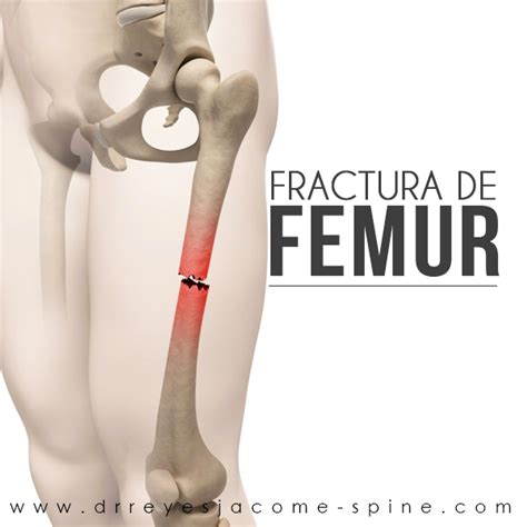 FRACTURA DE FEMUR - Cirugia de Columna en Matamoros