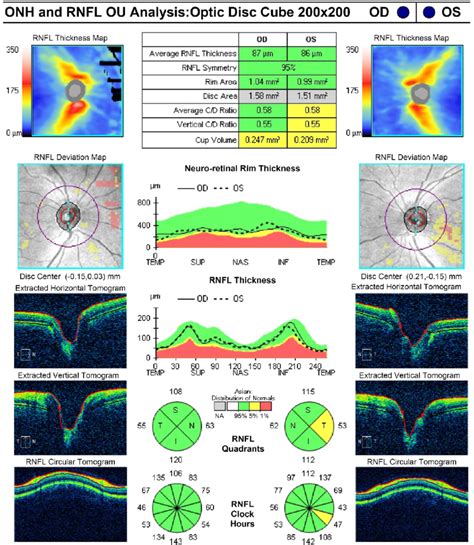 Normal RNFL thickness in optical coherence tomography. ONH = optic... | Download Scientific Diagram