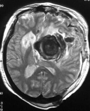 Brain Aneurysm Imaging: Overview, Computed Tomography, Magnetic Resonance Imaging