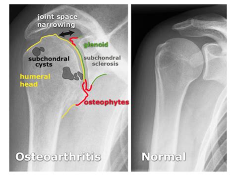 Glenohumeral Joint Degeneration