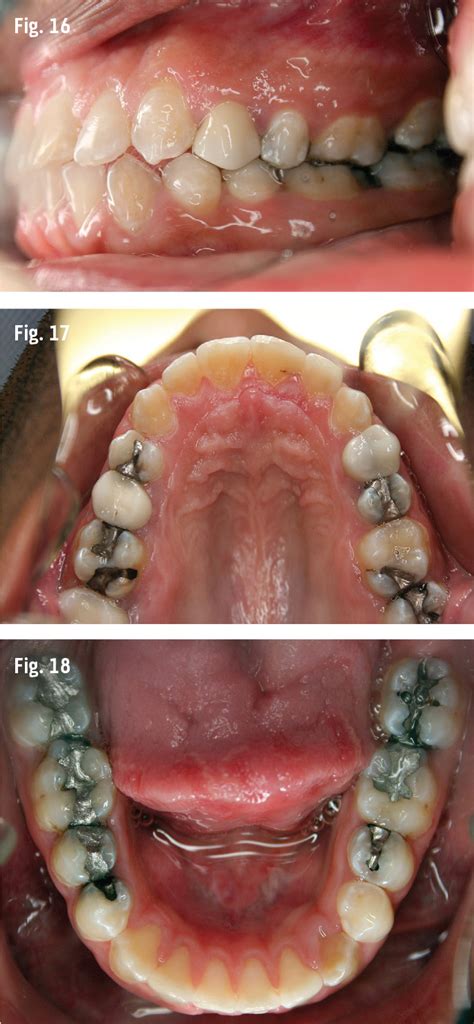 Anterior Open-Bite Treatment with Clear Aligners by Edward Davis, DMD ...